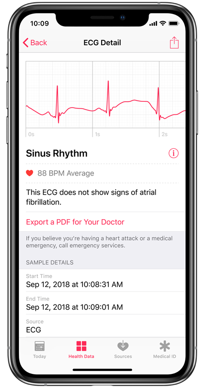 iPhone showing Sinus Rhythm ECG